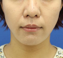 30代女性のバッカルファット除去 After 症例写真