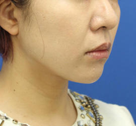 30代女性のシワ・たるみ After 症例写真