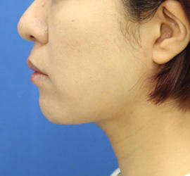 30代女性のバッカルファット除去 After 症例写真