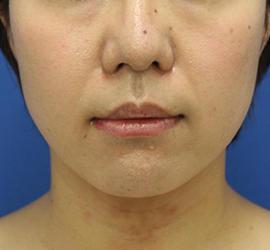 30代女性のバッカルファット除去 Before 症例写真
