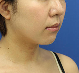 30代女性のシワ・たるみ Before 症例写真