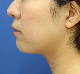 30代女性のバッカルファット除去 Before 症例写真