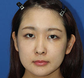 30代女性の目の下のクマ治療 After 症例写真