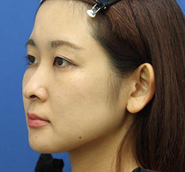 30代女性の3Dリポアイリフト  After 症例写真