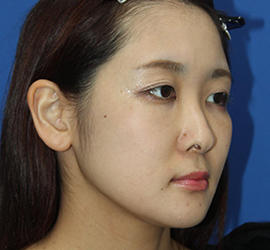 30代女性の3Dリポアイリフト  After 症例写真