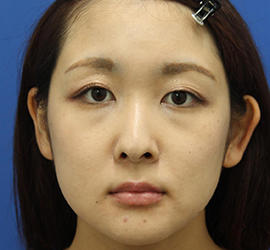 30代女性の目の下のクマ治療 Before 症例写真