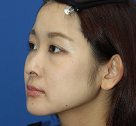 30代女性の3Dリポアイリフト  Before 症例写真