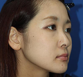 30代女性の3Dリポアイリフト  Before 症例写真