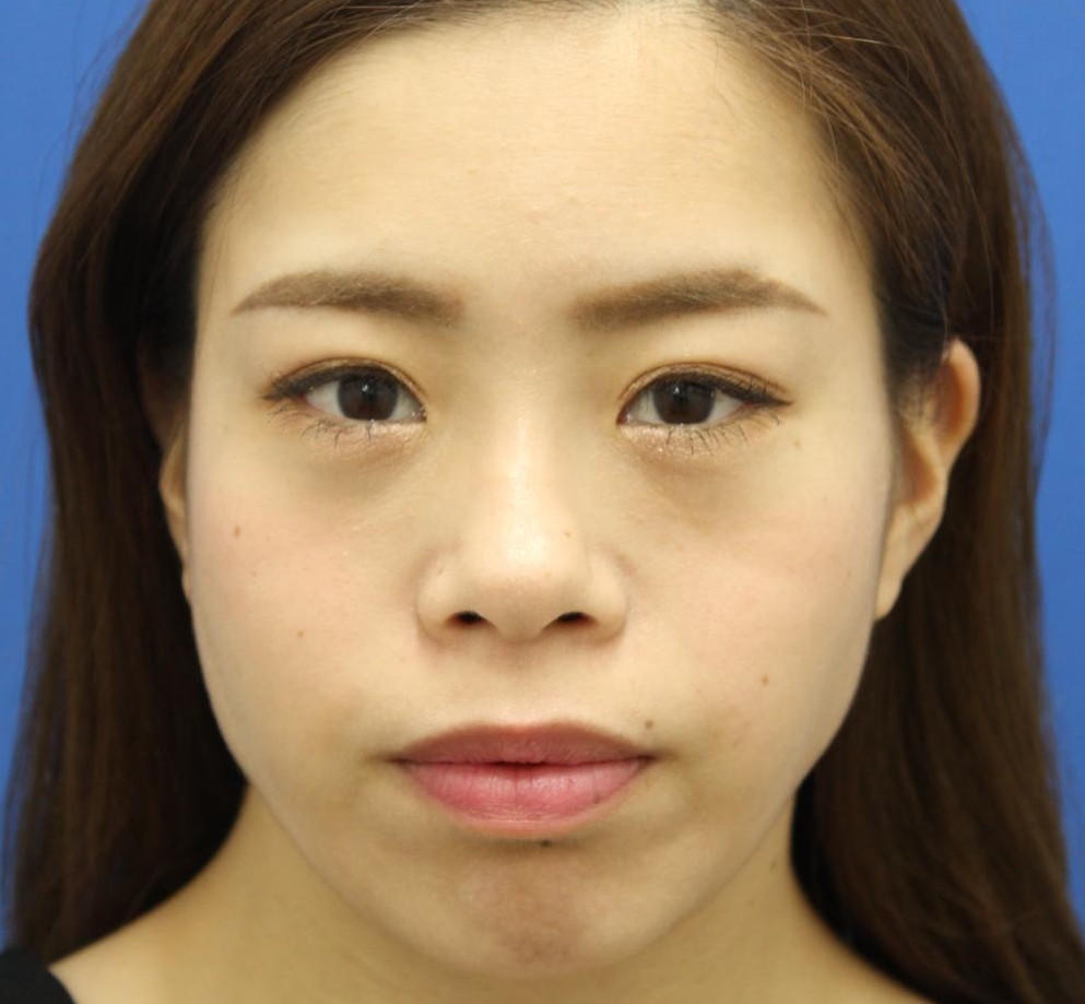 20代女性の目の下のクマ治療 After 症例写真