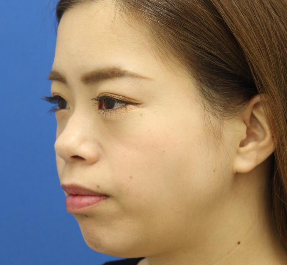 20代女性の3Dリポアイリフト  After 症例写真