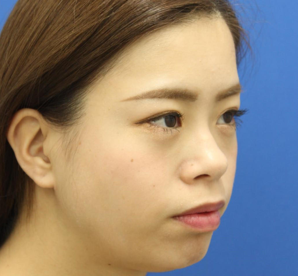 20代女性の3Dリポアイリフト  After 症例写真