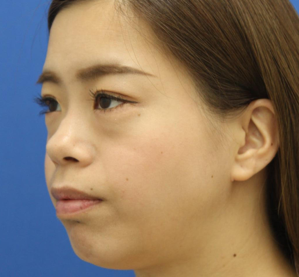 20代女性の3Dリポアイリフト  Before 症例写真