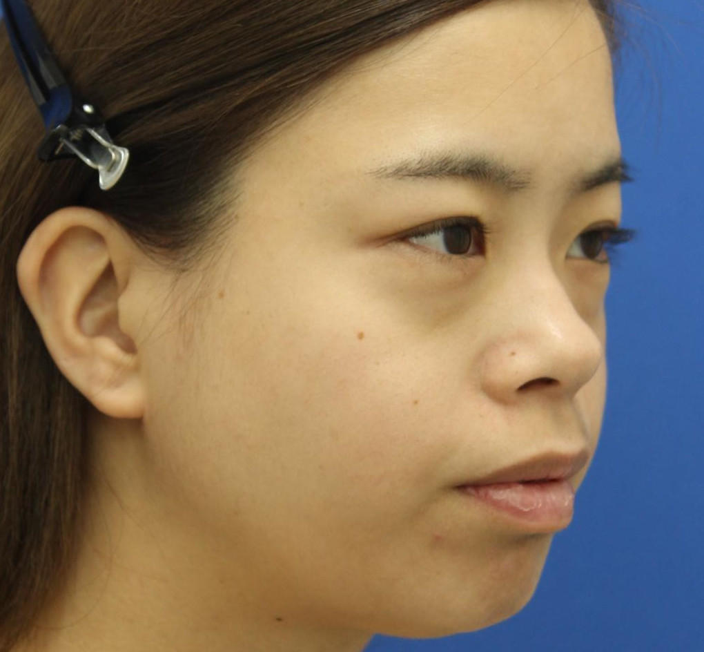 20代女性の3Dリポアイリフト  Before 症例写真