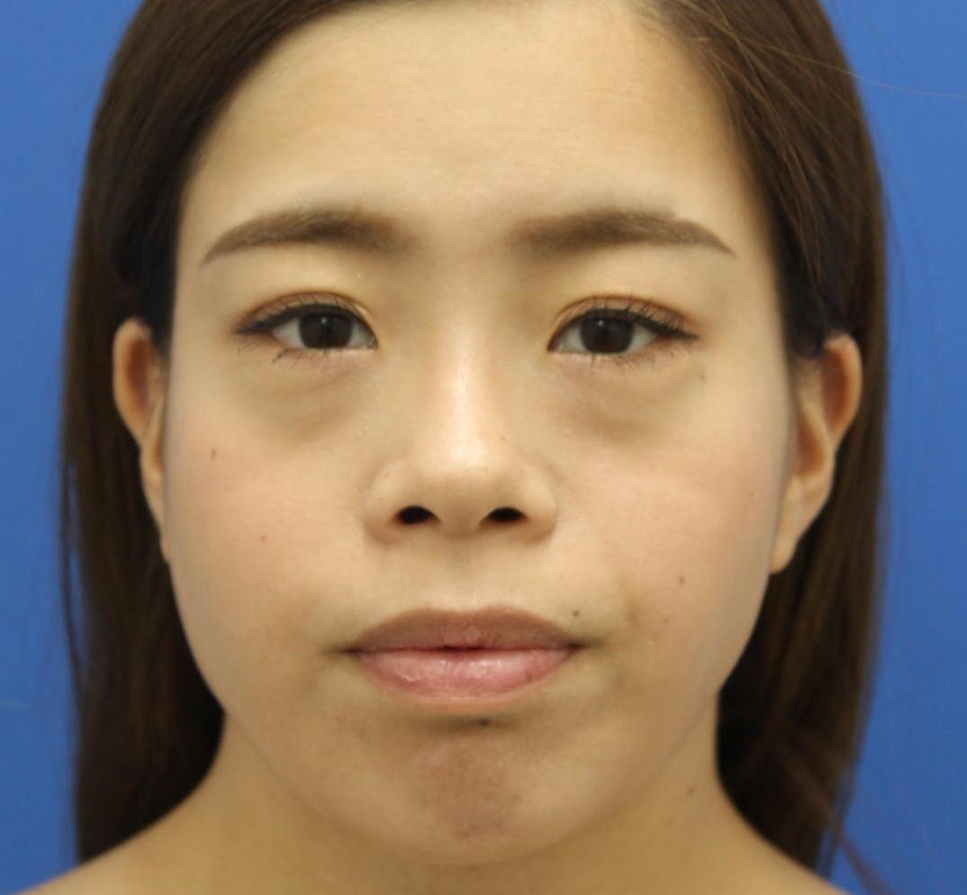 20代女性の目の下のクマ治療 Before 症例写真