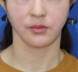 40代女性の顔の脂肪吸引  After 症例写真