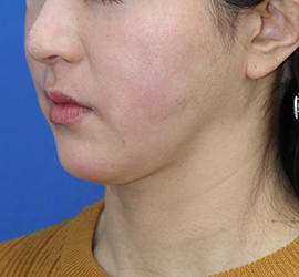 40代女性のシワ・たるみ After 症例写真