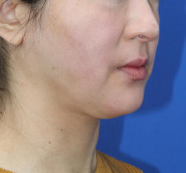 40代女性の顔の脂肪吸引  After 症例写真