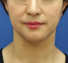 40代女性の顔の脂肪吸引  Before 症例写真