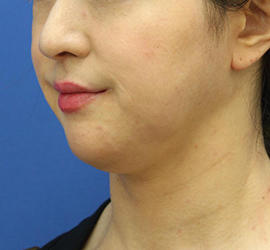 40代女性のシワ・たるみ Before 症例写真