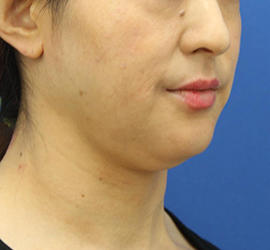 40代女性の顔の脂肪吸引  Before 症例写真