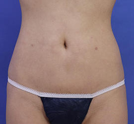 30代女性の脂肪吸引 After 症例写真