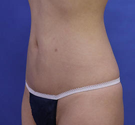 30代女性の脂肪吸引 After 症例写真