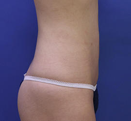 30代女性の脂肪吸引 After 症例写真