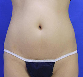 30代女性の脂肪吸引 Before 症例写真