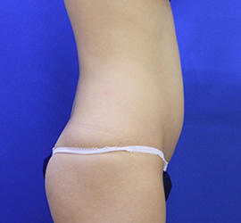 30代女性の脂肪吸引 Before 症例写真