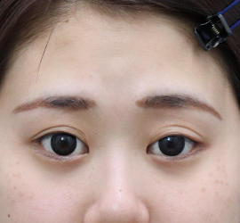 20代女性のタレ目・でか目形成 After 症例写真