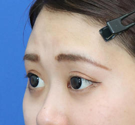 20代女性の二重整形・目元の整形 After 症例写真