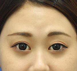 20代女性のタレ目・でか目形成 Before 症例写真