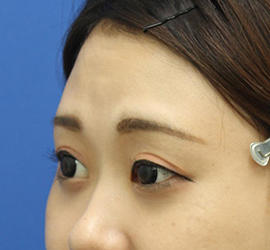 20代女性の二重整形・目元の整形 Before 症例写真