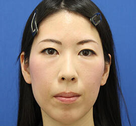 30代女性の肌再生高純度脂肪注入（脂肪移植） After 症例写真