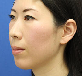 30代女性の肌再生高純度脂肪注入（脂肪移植） After 症例写真