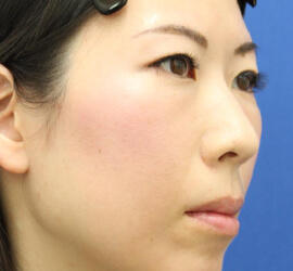 30代女性の肌再生高純度脂肪注入（脂肪移植） After 症例写真