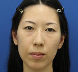 30代女性の肌再生高純度脂肪注入（脂肪移植） Before 症例写真