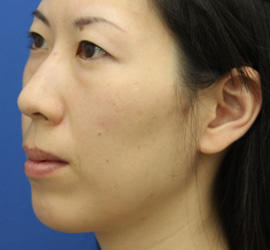 30代女性の肌再生高純度脂肪注入（脂肪移植） Before 症例写真