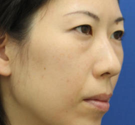 30代女性の肌再生高純度脂肪注入（脂肪移植） Before 症例写真