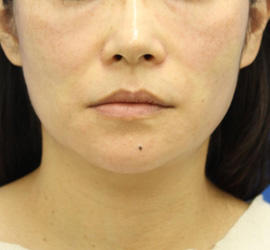 40代女性のVOVリフトプレミアム After 症例写真