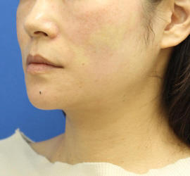 40代女性のVOVリフトプレミアム After 症例写真