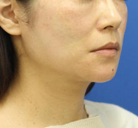 40代女性のVOVリフトプレミアム After 症例写真