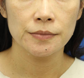 40代女性のVOVリフトプレミアム Before 症例写真