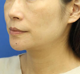 40代女性のVOVリフトプレミアム Before 症例写真