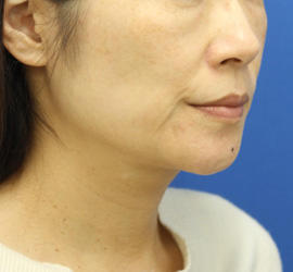 40代女性のVOVリフトプレミアム Before 症例写真