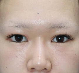 20代女性のタレ目・でか目形成 After 症例写真