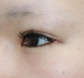 20代女性のタレ目・でか目形成 After 症例写真