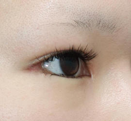 20代女性のタレ目・でか目形成 After 症例写真