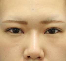 20代女性のタレ目・でか目形成 Before 症例写真