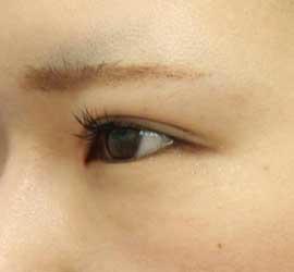 20代女性のタレ目・でか目形成 Before 症例写真